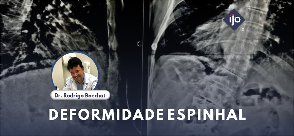 DEFORMIDADE ESPINHAL POR DR RODRIGO BOECHAT – CIRURGIA DE COLUNA